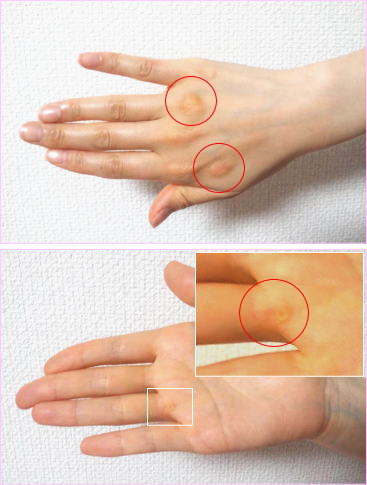 吐きだこ モデル:女性 吐きダコ画像